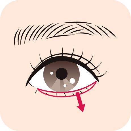 グラマラスライン形成術