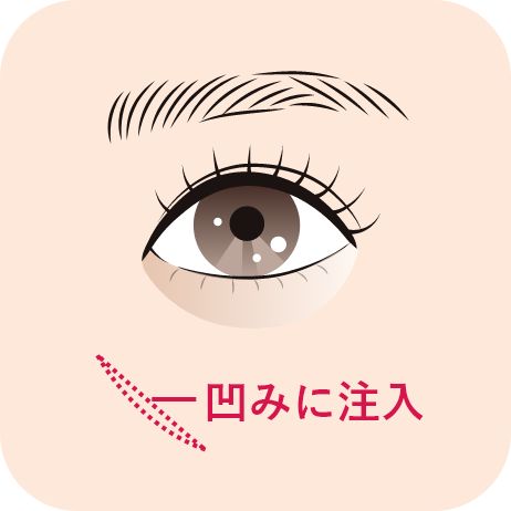 眼の下のヒアルロン酸