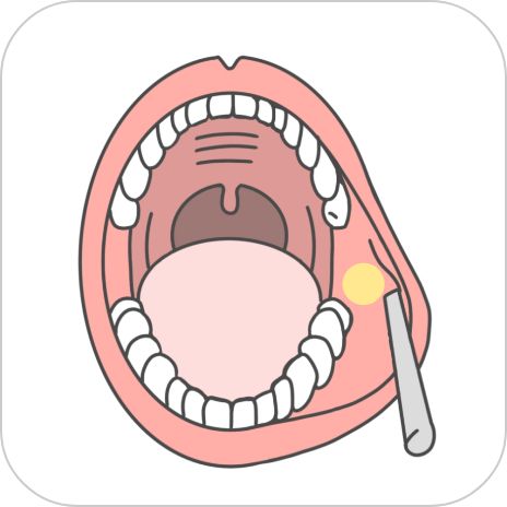 バッカルファット除去術
