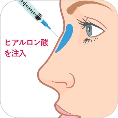 鼻のヒアルロン酸