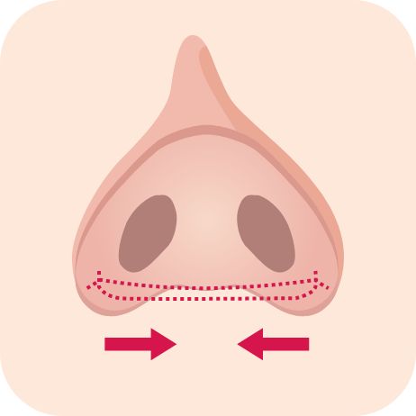 鼻翼縮小術