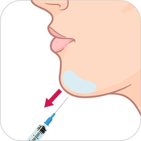 アゴのヒアルロン酸