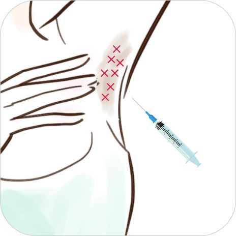 ワキボトックス